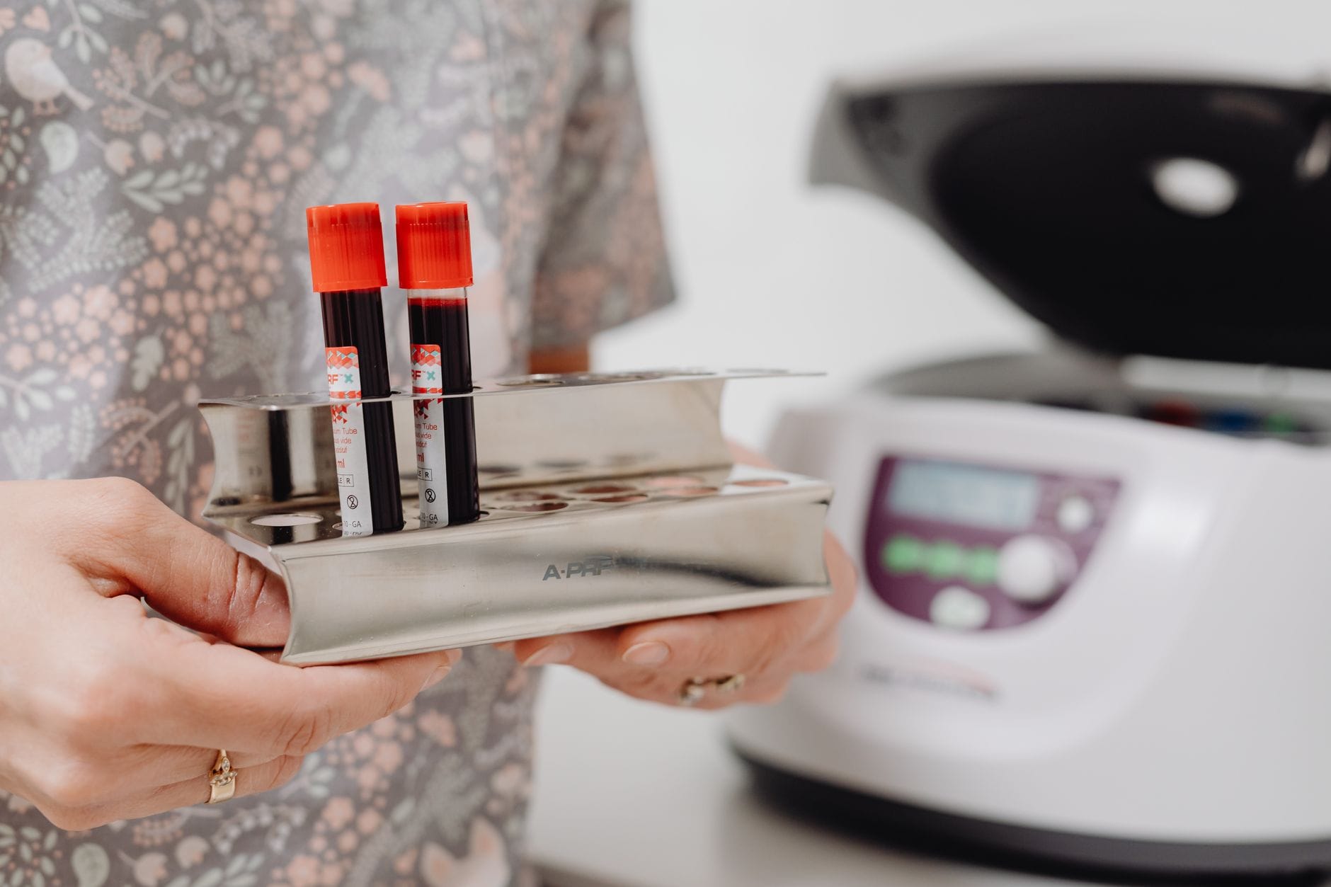 Cholesterol na diecie wysokobiałkowej: jak interpretować lipidogram bez paniki? Probówki z krwią w laboratorium przygotowane do badania cholesterolu